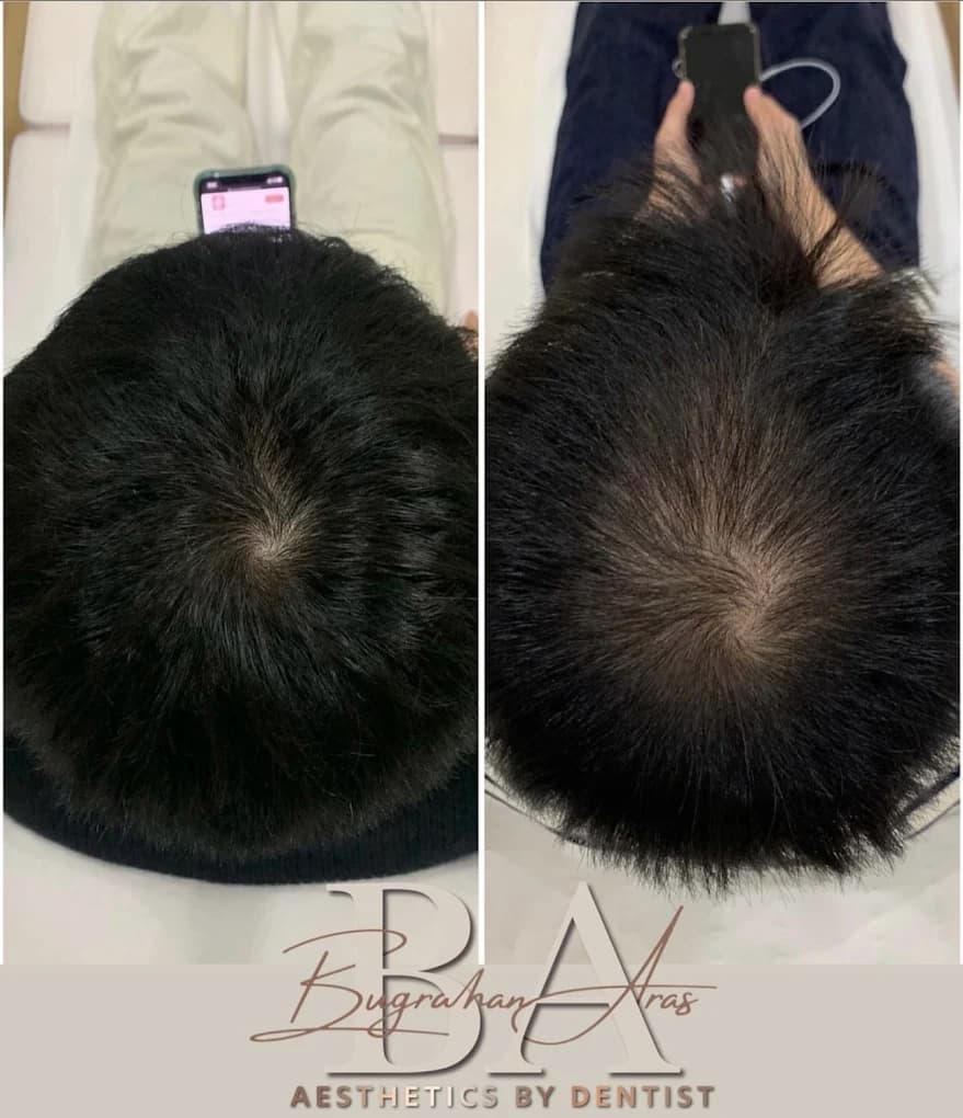 Hair loss treatment before and after BA Aesthetics Chatham
