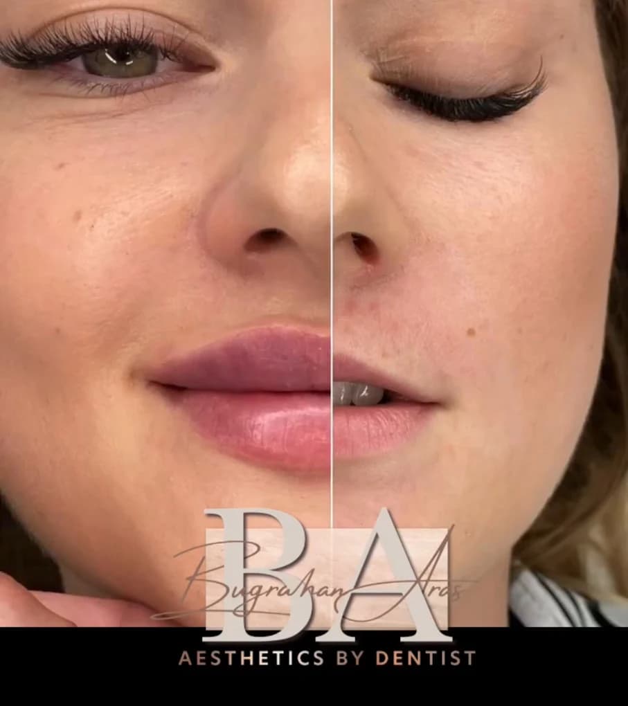Lip fillers before and after BA Aesthetics Chatham