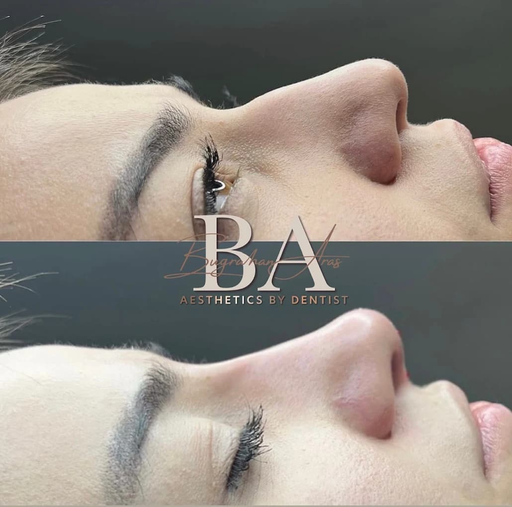 Non-surgical rhinoplasty BA Aesthetics by Dentist Chatham